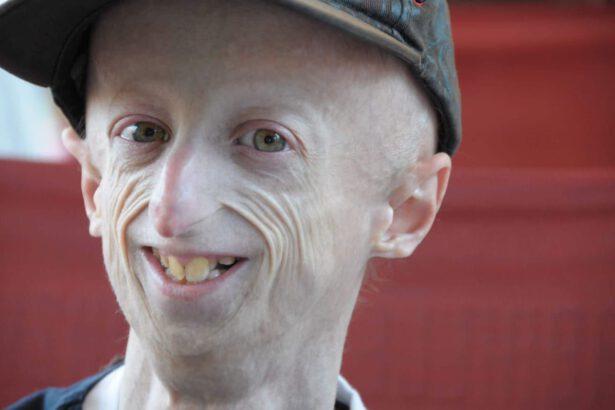 Approvato il farmaco contro la progeria sperimentato da Sammy Basso 11