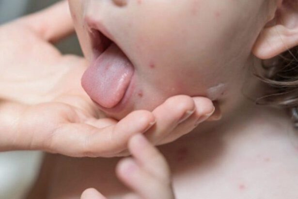 Coronavirus e Malattia di Kawasaki. I bambini sono in pericolo? 10