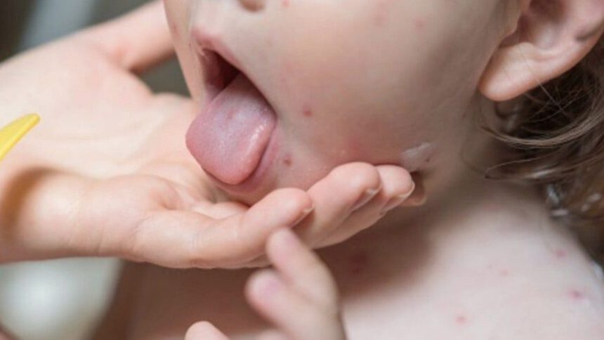 Coronavirus e Malattia di Kawasaki. I bambini sono in pericolo? 2 Coronavirus e Malattia di Kawasaki. I bambini sono in pericolo? 1