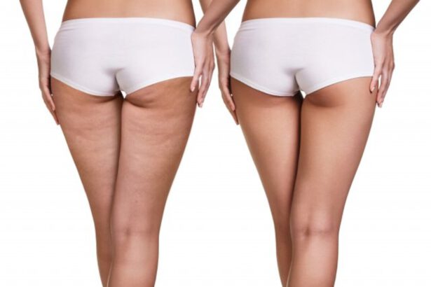 Addio alle culotte de cheval: ecco come combatterle in vista della prova costume 10