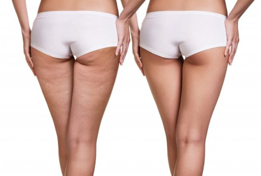 Addio alle culotte de cheval: ecco come combatterle in vista della prova costume 1