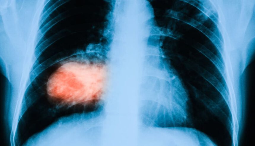 Farmaco sperimentale blocca tumori solidi, Sellers: "Obiettivo perseguito in anni di ricerca" 1