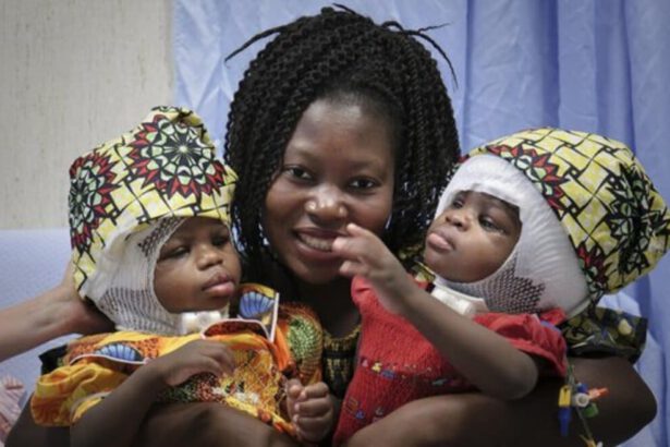 Gemelline siamesi separate a Roma, la mamma: "Avete fatto risuscitare le mie figlie" 10