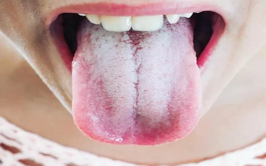 Lingua bianchissima, da cosa dipende? 3 lingua bianchissima da cosa dipende