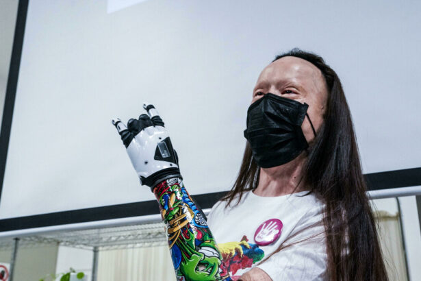 Sfigurata col fuoco, oggi Valentina Pitzalis ha una mano bionica: "Mi sento Wonder Woman" 15