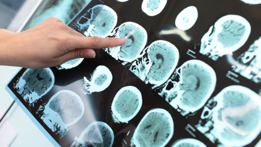 Alzheimer e Parkinson, possibile nuova cura con vaccini e farmaci mRNA 1