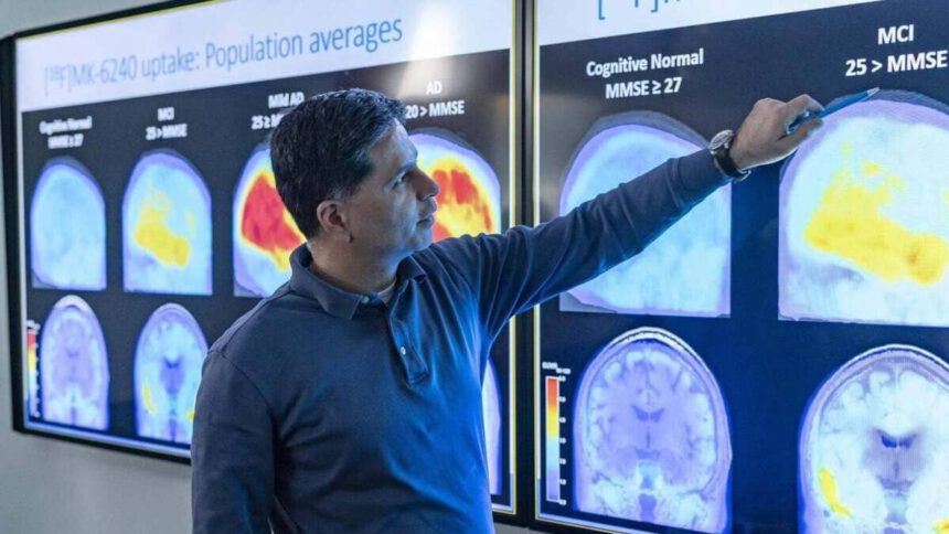 Alzheimer, ci sarà il vaccino? E come agisce? 1