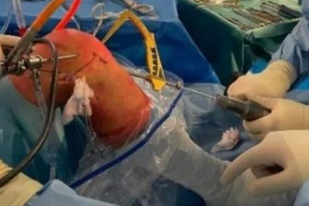 Dona il tendine crociato del suo ginocchio al figlio: primo trapianto da vivo in Italia 13