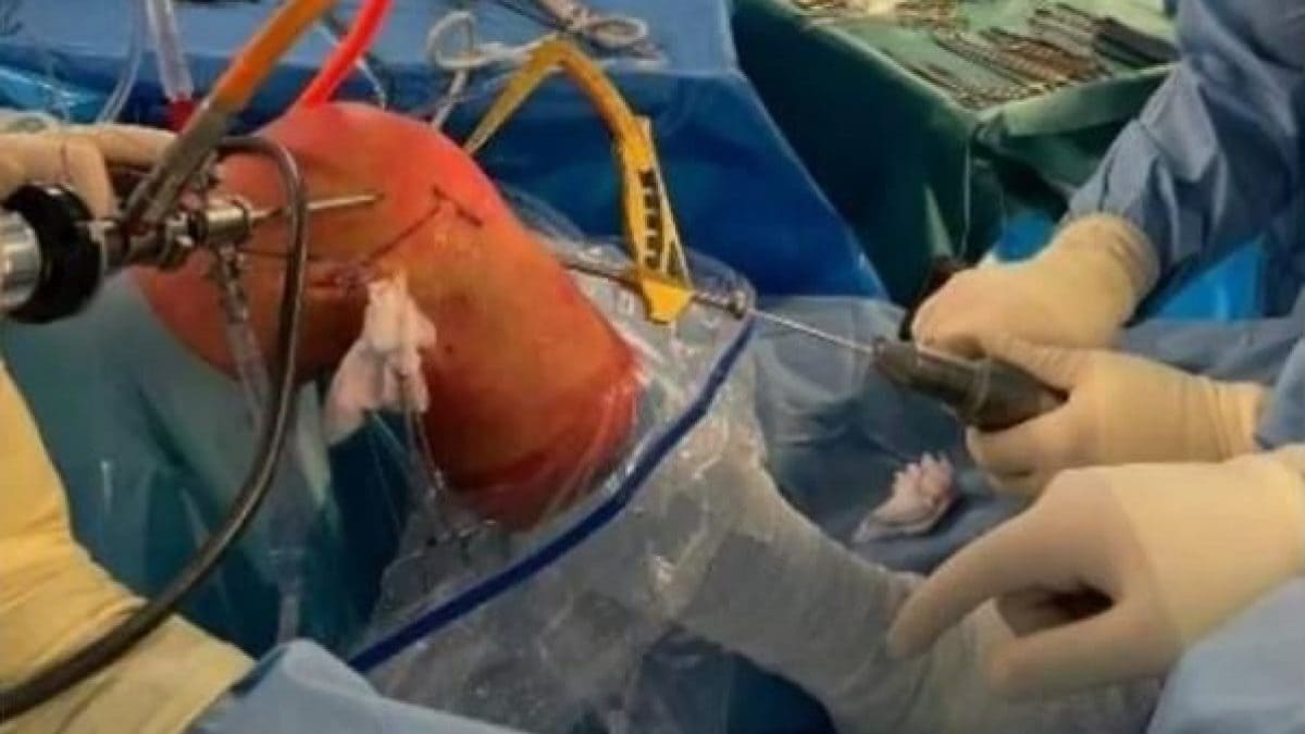 Dona il tendine crociato del suo ginocchio al figlio: primo trapianto da vivo in Italia 15