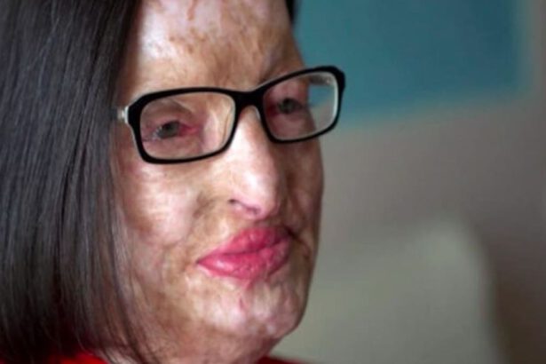 Filomena Lamberti, sfigurata con l'acido dal marito: "Lui ha patteggiato 18 mesi. Io vivo con 300 euro" 18