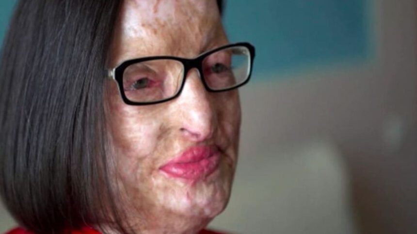 Filomena Lamberti, sfigurata con l'acido dal marito: "Lui ha patteggiato 18 mesi. Io vivo con 300 euro" 1