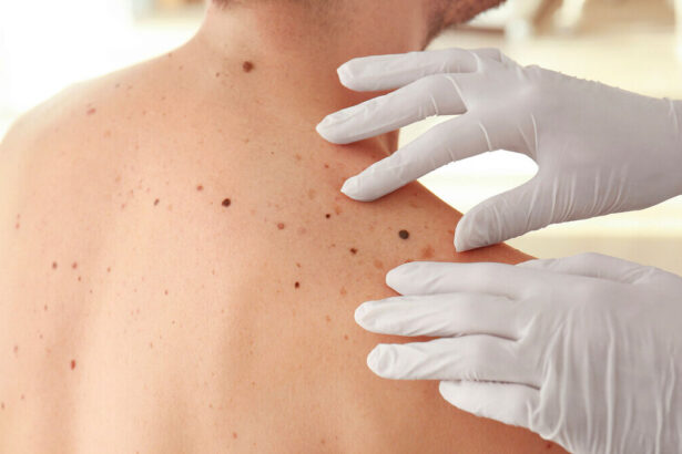 <strong>Quali sono i nei pericolosi e come si riconoscono?</strong> 5