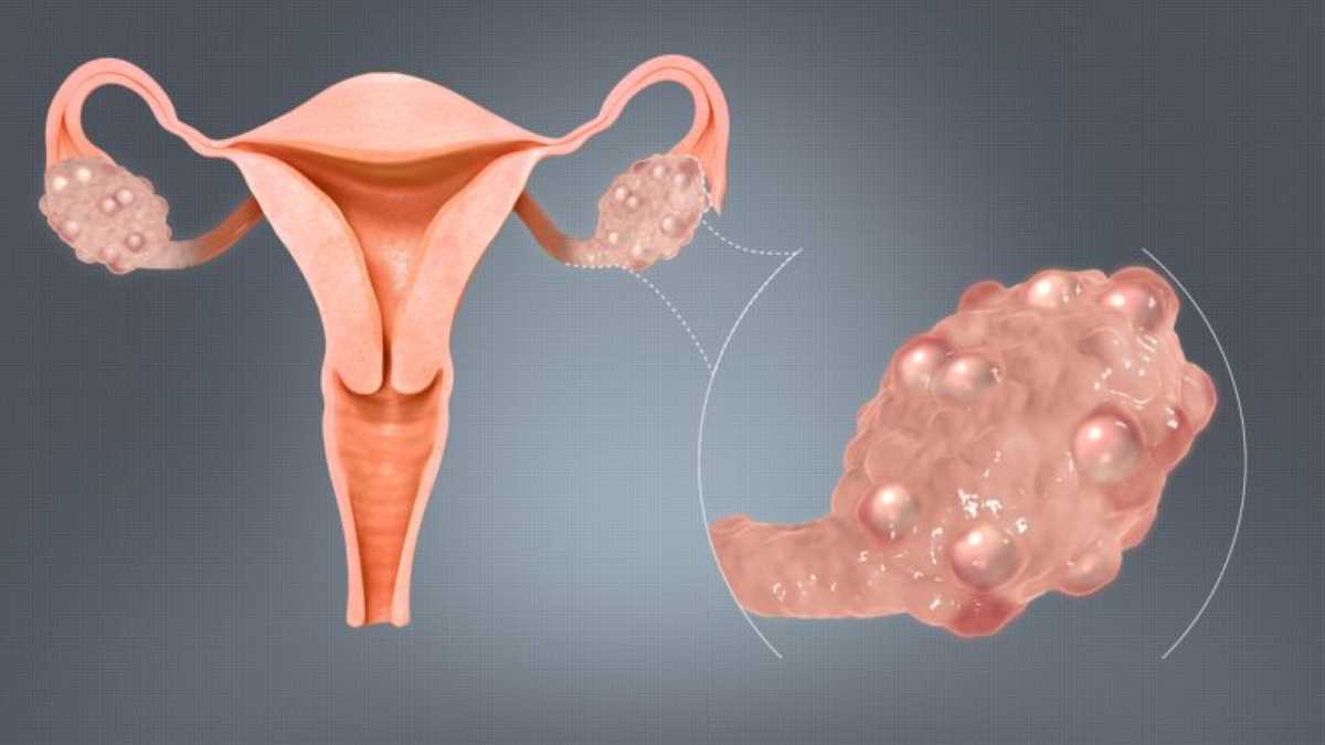 Cancro alle ovaie: nuovi trattamenti e borse di studio per la ricerca 13