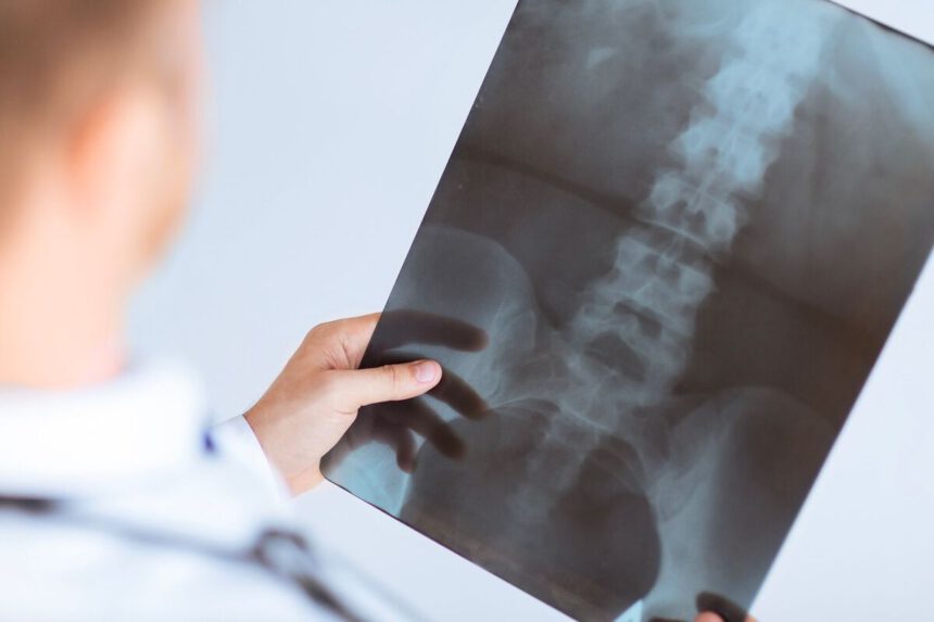 Non cammina senza busto, pazienti, medici e infermieri glielo regalano: "Sono come una famiglia" 1