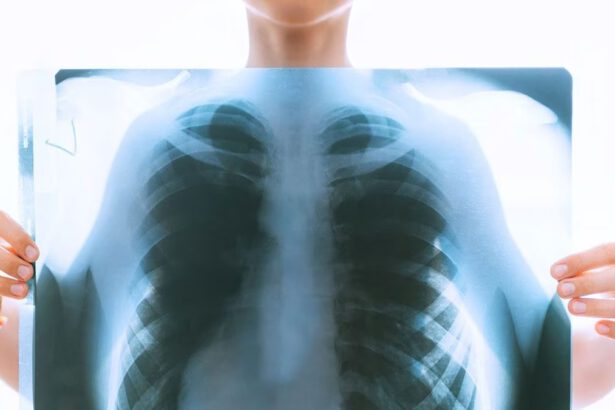 Tumore al polmone, diagnosi precoce grazie a una piattaforma robotica 14