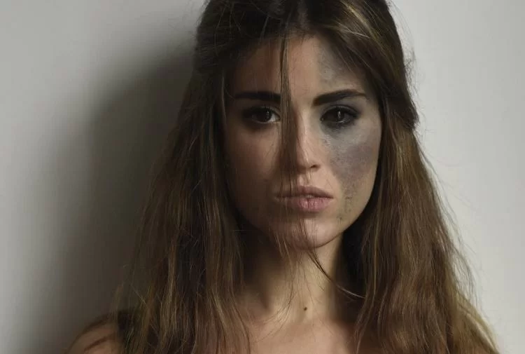 Chi è Carlotta Bertotti, la bellissima modella con un nevo di Ota sul volto 4