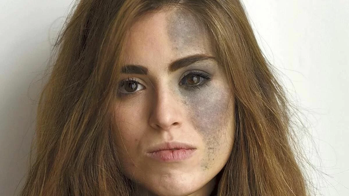 Chi è Carlotta Bertotti, la bellissima modella con un nevo di Ota sul volto 13