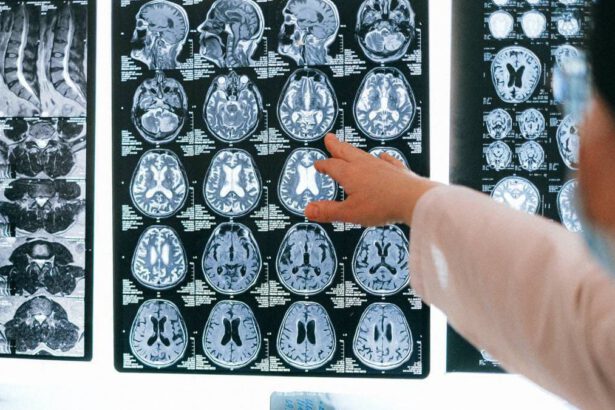 Il cervello invecchia di 20 anni: ecco cosa rischiano i malati gravi di Covid 70