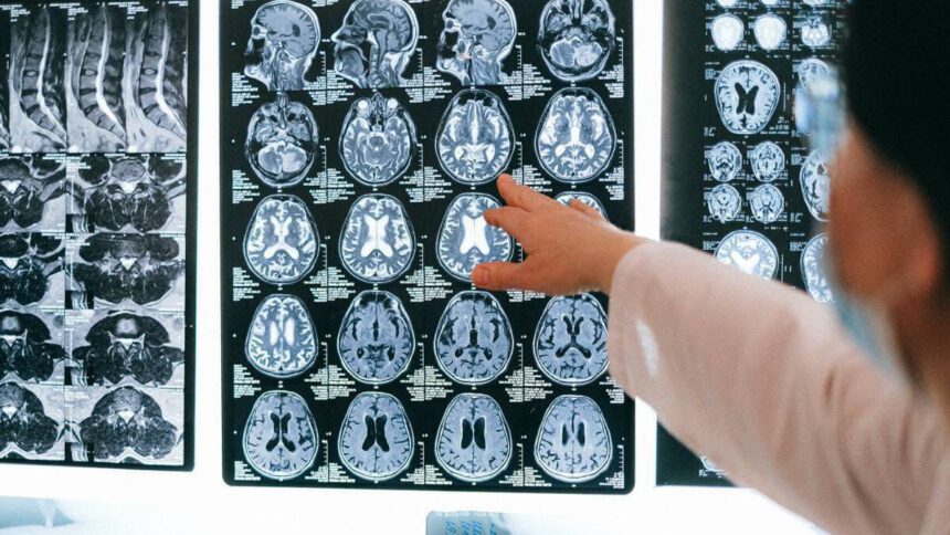 Il cervello invecchia di 20 anni: ecco cosa rischiano i malati gravi di Covid 1