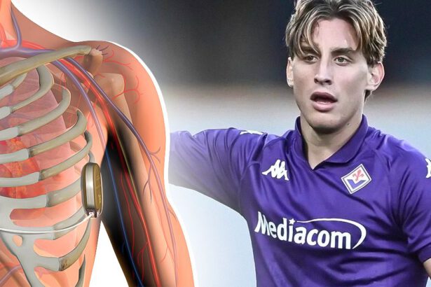 Edoardo Bove, come funziona il defibrillatore sottocutaneo e quando può essere rimosso 15