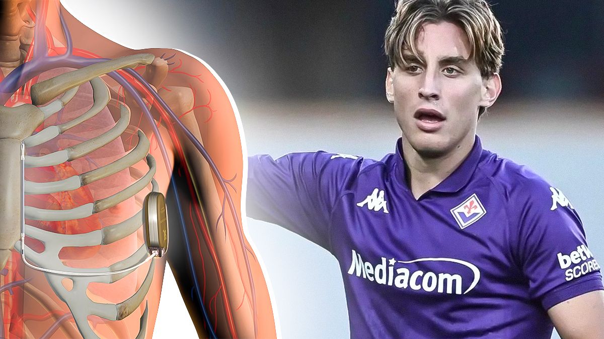 Edoardo Bove, come funziona il defibrillatore sottocutaneo e quando può essere rimosso 13