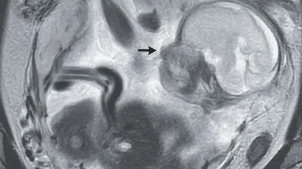 Sma curata in utero, primo caso al mondo 3