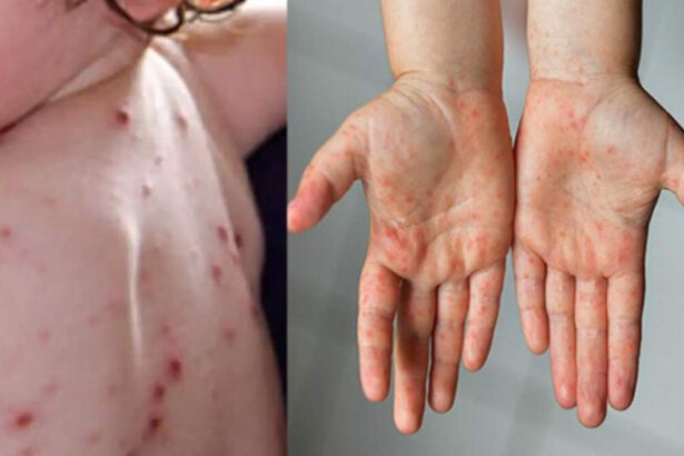 Influenza del pomodoro: nuovo virus colpisce i bambini con febbre e ulcere 11