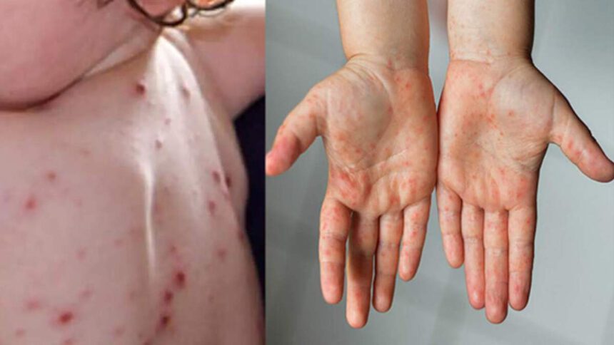 Influenza del pomodoro: nuovo virus colpisce i bambini con febbre e ulcere 1