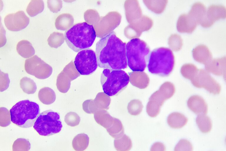 Leucemia mieloide acuta, una nuova cura in compresse riduce il rischio ricadute 3