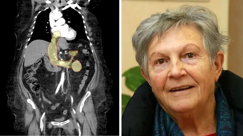 Anna, operata a cuore fermo per un tumore: “Non fate come me che per due anni non ho fatto controlli” 3 rimuovere un tumore_