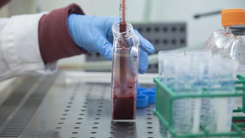 Sclerosi multipla: scoperta terapia che disattiva malattia nel 70% dei pazienti 1