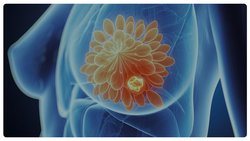 Tumore al seno metastatico: qual è la nuova cura che diminuisce il rischio di morte? 2 Tumore al seno metastatico: qual è la nuova cura che diminuisce il rischio di morte? 1