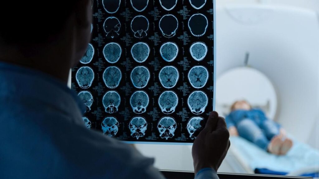 Rivoluzione sclerosi multipla, un biomarcatore rivela i segnali invisibili 3