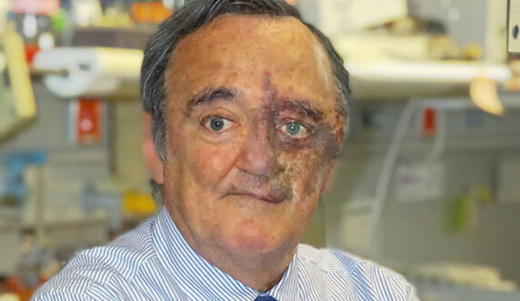 Tumore al pancreas, la cura sarebbe in un mix di tre farmaci: lo studio di Barbacid 2 tumore al pancreas studio rivoluzionario