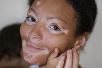 vitiligine