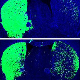 Cervello con Parkinson prima e dopo il trattamento