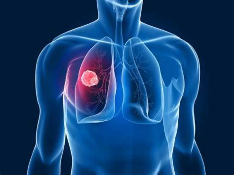 Farmaco sperimentale blocca i tumori solidi tra cui quello al polmone.