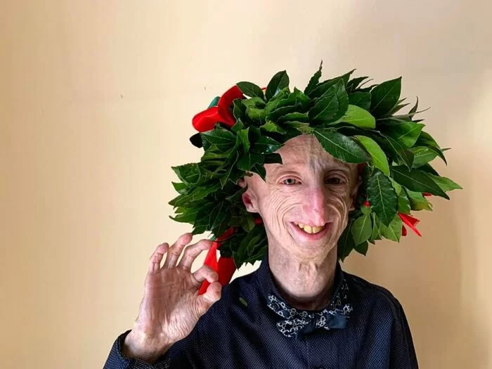 Sammy Basso si laurea per la seconda volta: il giovane affetto da progeria è dottore in Molecular Biology