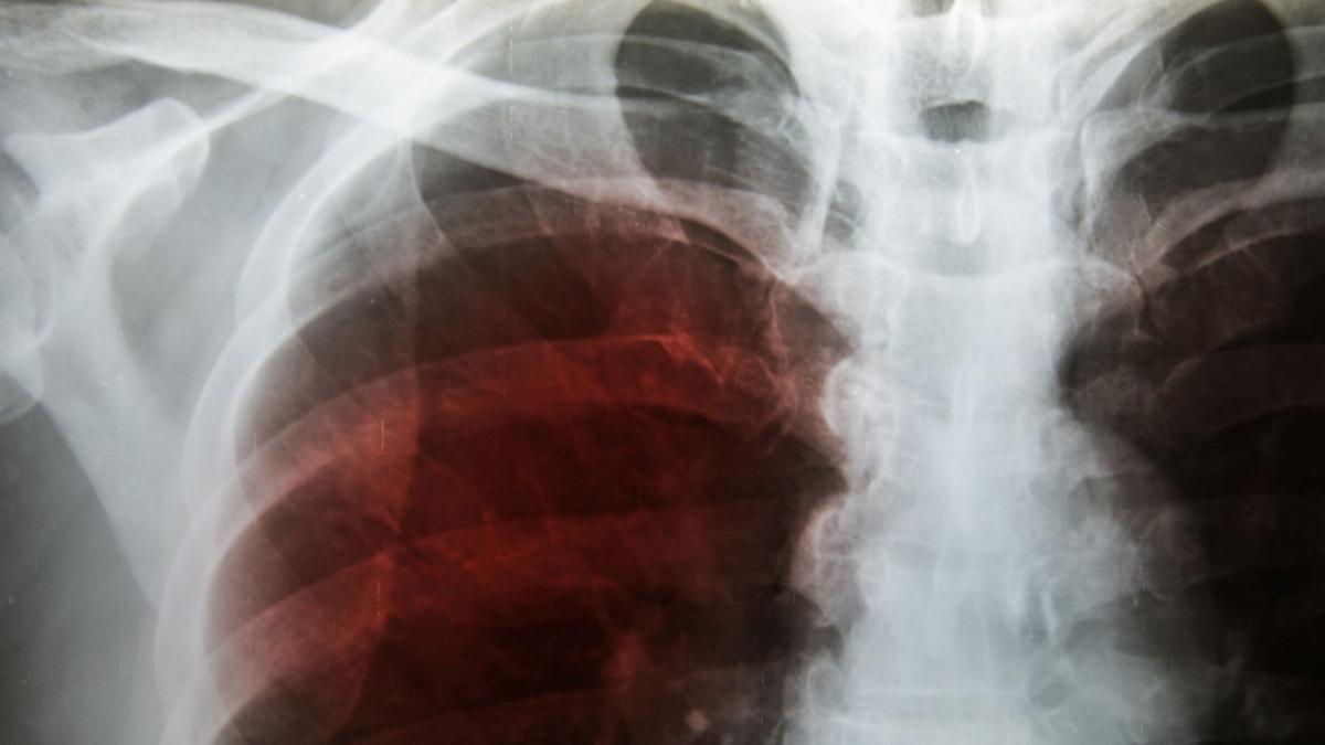 Che cos’è e come si cura la polmonite bilaterale, patologia di Papa Francesco 3